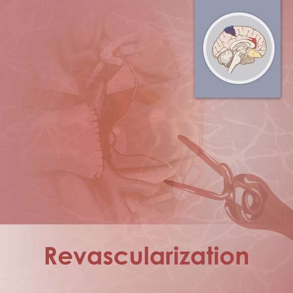 Revascularization – The Neurosurgical Atlas